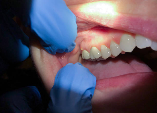 Best Emergency Treatment for Dental Infections or Abscesses in Johnstown, CO