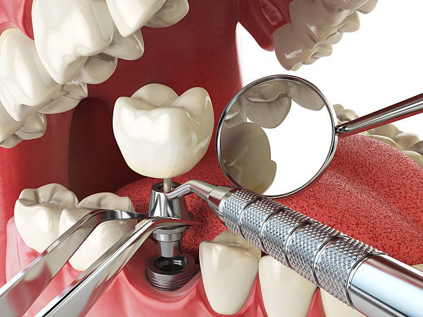 Best Emergency Tooth Extraction in Johnstown, CO